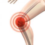 Gonarthrose. Das sind Typische Symptome